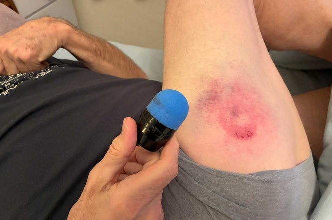 KSTP-TV photojournalist Joe Caffrey displays a large bruise on his thigh and the sponge-tipped munition he believes struck him while he was documenting protests following the fatal shooting of Alex Pretti in Minneapolis, Minnesota, on Jan. 24, 2026.