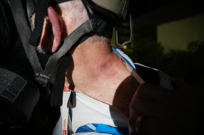 Photographer John Rudoff’s neck after he was struck with an impact projectile while covering an immigration protest in Portland, Oregon, in October 2025.