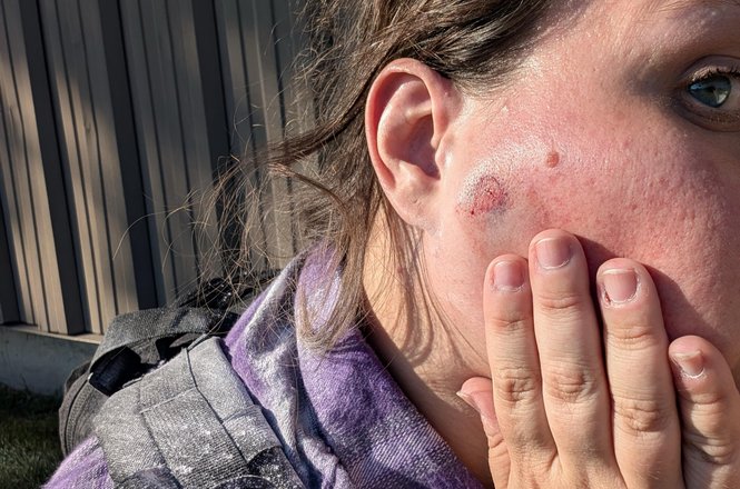 Reporter Raven Geary was shot in the face with a pepper ball by federal officers while reporting on anti-deportation protests at a U.S. Immigration and Customs Enforcement facility in the Chicago suburb of Broadview, Illinois, on Sept. 26, 2025.
