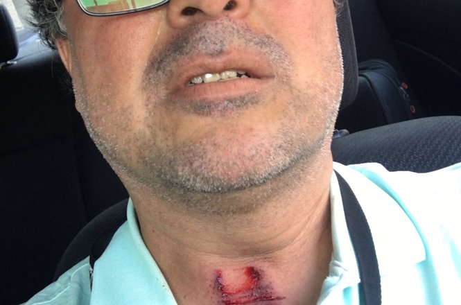 While covering Long Beach, California, protests on May 31, KPCC/LAist reporter Adolfo Guzman-Lopez was hit by a rubber bullet fired by police. He posted this selfie shortly after, and was treated at a hospital for the injury. (COURTESY ADOLFO GUZMAN-LOPEZ) Guzman_Lopez_assault_0531_CA.jpg