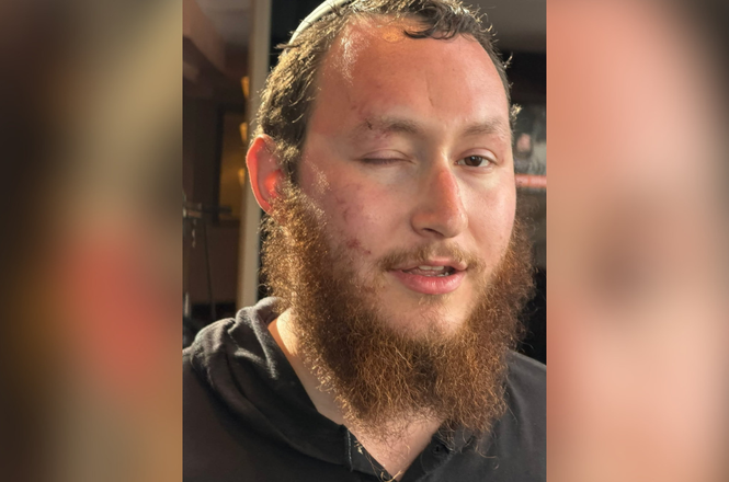 Independent reporter Yaakov Strasberg with visible facial injuries, two days after he was arrested and punched by police while covering an immigration protest on May 31, 2026, in Newark, New Jersey.