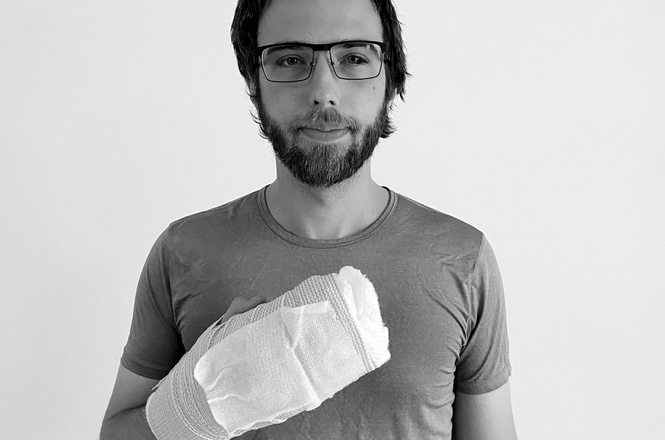 Two bones were broken in the ring finger of Minneapolis Star Tribune photojournalist Mark Vancleave, who was struck with a rubber bullet while covering protests in Brooklyn Center, Minnesota, on April 12, 2021. (COURTESY OF MARK VANCLEAVE) Vancleave_assault_041221.png