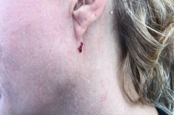 Reporter Tina-Desiree Berg shows the blood blister left after a woman took Berg's iPhone and then hit her while she was interviewing at a regional meeting of the California Democratic Party. (COURTESY TINA-DESIREE BERG) berg_attack